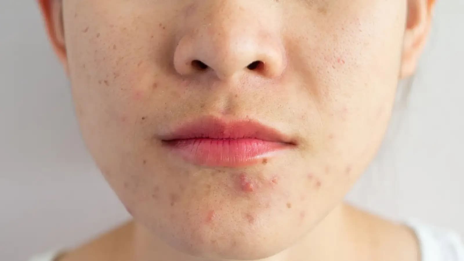 5 skincare hacks to fight acne when the season changes